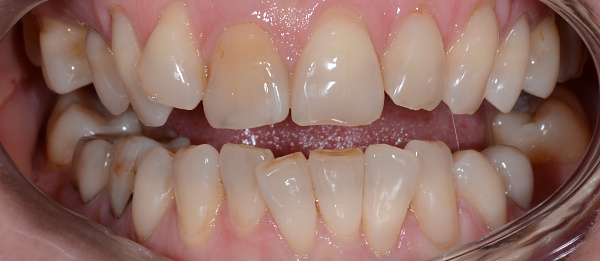  Устранение сужения зубных рядов, скученности зубов, дистальной окклюзии до