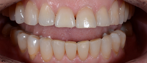 Устранение перекрестного прикуса, нарушения формы зубных рядов, скученности зубов после