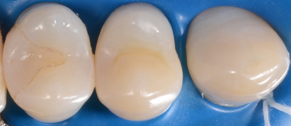 Лечение кариеса, художественная реставрация зубов до