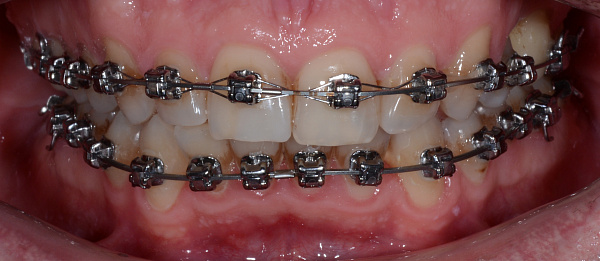 Профессиональная гигиена полости рта во время ортодонтического лечения до