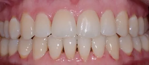 Коррекция прикуса и положения зубов после