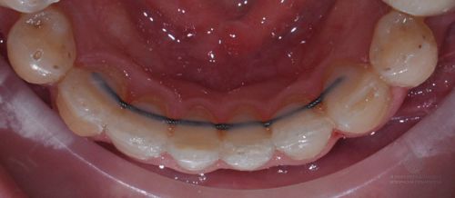 Коррекция скученности зубов нижней челюсти после