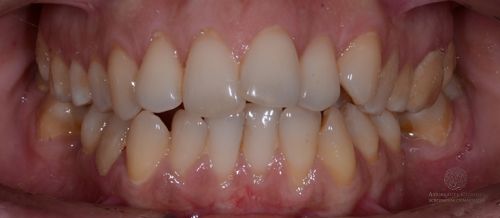 Устранение дистальной окклюзии и скученности зубов до