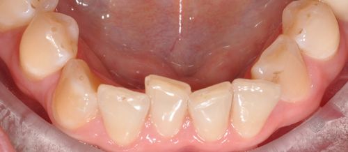 Коррекция скученности зубов нижней челюсти до