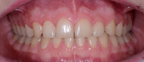 Коррекция наклона передних зубов и глубины прикуса после