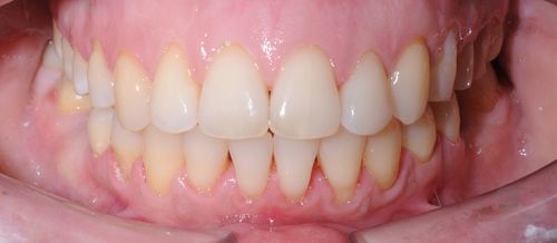 Устранение дистальной окклюзии и скученности зубов после