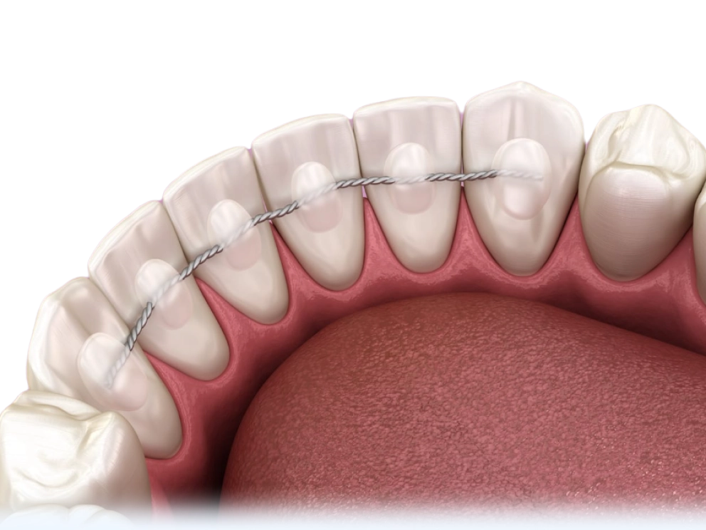 Ретенция, стабильность результатов ортодонтического лечения