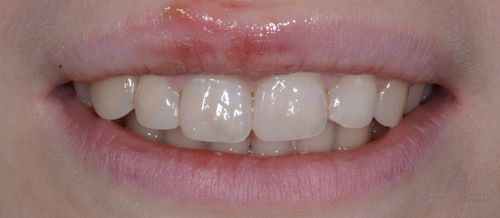 Реставрация зуба после травмы после