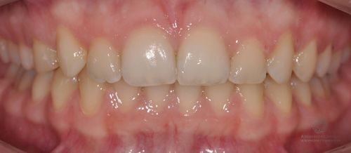 Коррекция глубокой дистальной окклюзии и положения зубов после