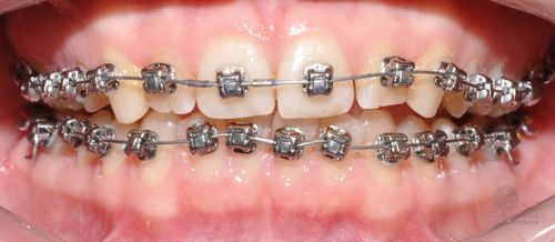 Коррекция глубокой дистальной окклюзии и положения зубов до