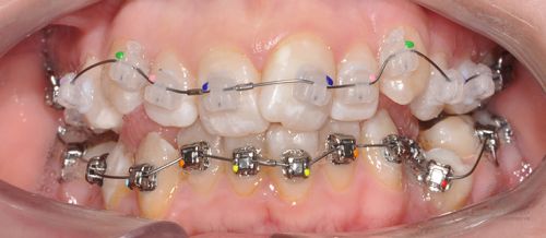 Коррекция прикуса и положения зубов до
