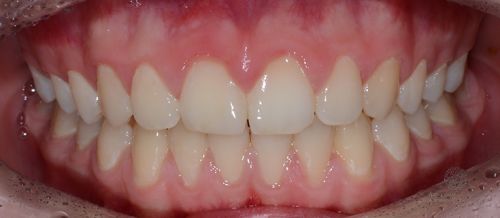 Коррекция положения зубов верхней челюсти после