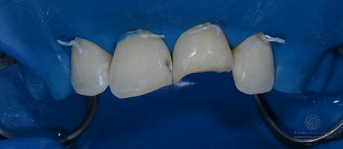 Реставрация зуба после травмы до