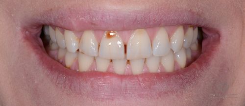Отбеливание ZOOM4, художественная реставрация зубов до