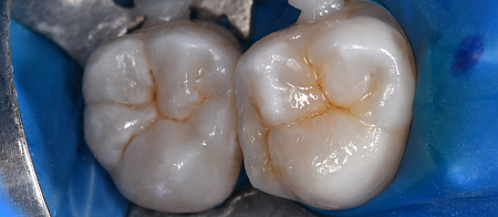 Лечение кариеса, художественная реставрация зубов