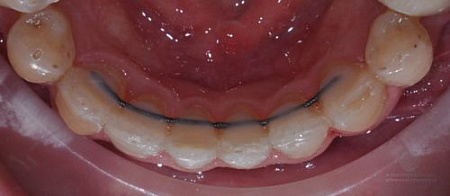 Коррекция скученности зубов нижней челюсти