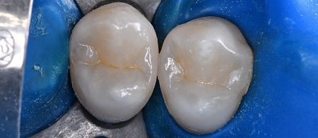 Лечение кариеса, художественная реставрация зубов
