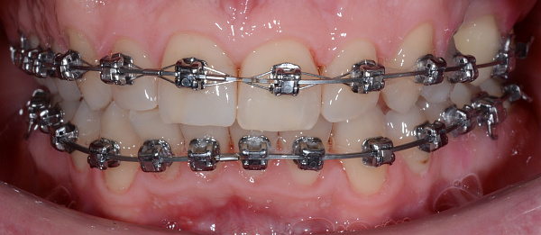 Профессиональная гигиена полости рта во время ортодонтического лечения после