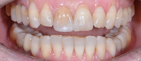  Устранение сужения зубных рядов, скученности зубов, дистальной окклюзии
