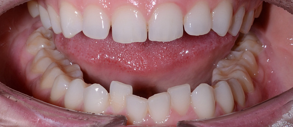 Устранение сужения зубных рядов, скученности зубов до