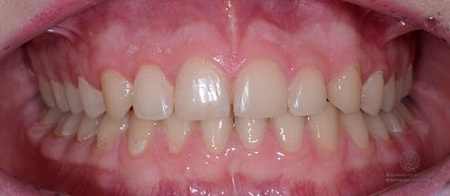 Коррекция наклона передних зубов и глубины прикуса