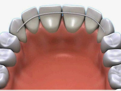 Аномалии положения зубов в различных направлениях