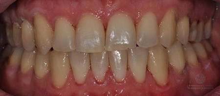 Коррекция прикуса и положения зубов