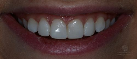 Отбеливание ZOOM4, художественная реставрация зубов