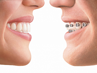 Этапы ортодонтического лечения
