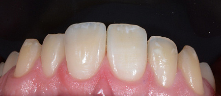 Реставрация зуба после травмы