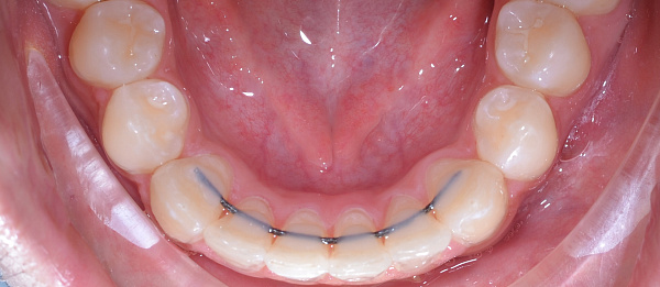 Лечение рецидива после проведённого ранее ортодонтичнского лечения после