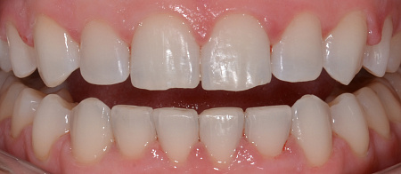 Устранение сужения зубных рядов, скученности зубов