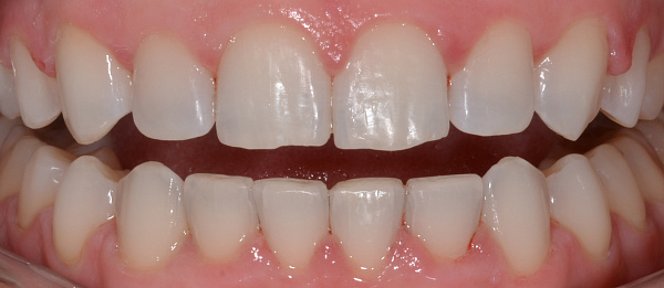 Устранение сужения зубных рядов, скученности зубов после