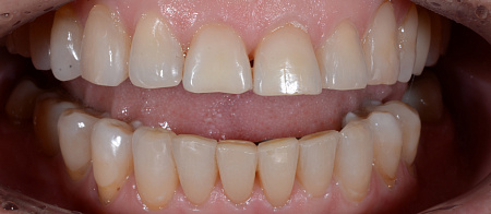 Устранение перекрестного прикуса, нарушения формы зубных рядов, скученности зубов