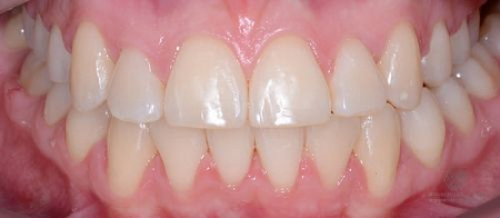 Коррекция прикуса и положения зубов