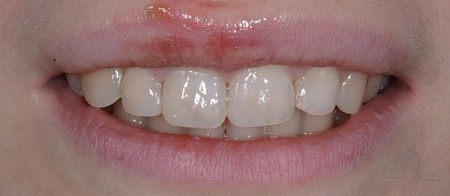 Реставрация зуба после травмы