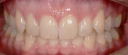 Устранение глубокого дистального прикуса, сужения зубных рядов и скученности зубов