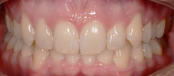 Устранение глубокого дистального прикуса, сужения зубных рядов и скученности зубов после