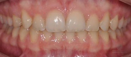 Коррекция глубокой дистальной окклюзии и положения зубов