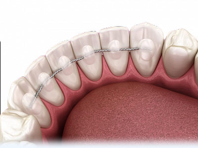 Ретенция, стабильность результатов ортодонтического лечения