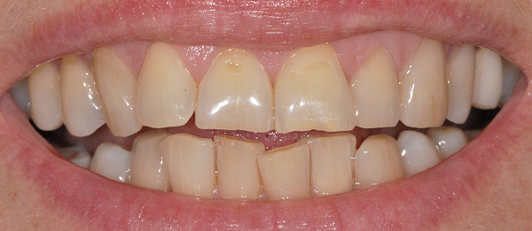 Устранение перекрестного прикуса, нарушения формы зубных рядов, скученности зубов до