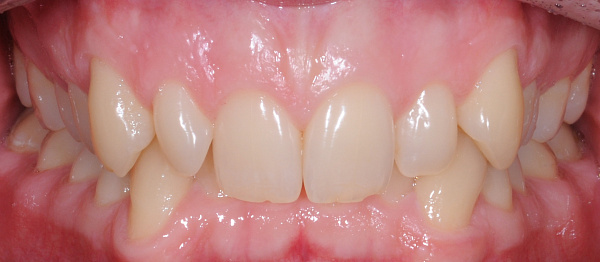 Устранение глубокого дистального прикуса, сужения зубных рядов и скученности зубов до