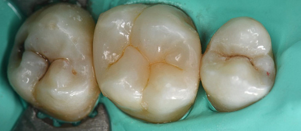 Лечение кариеса, художественная реставрация зубов после