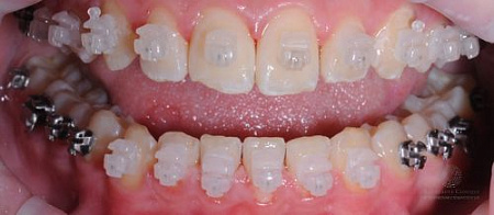 Профессиональная гигиена полости рта во время ортодонтического лечения