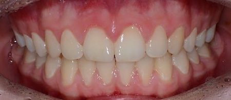 Коррекция положения зубов верхней челюсти