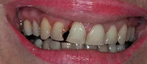 Художественная реставрация зубов до