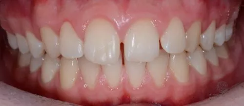 Коррекция положения зубов верхней челюсти до
