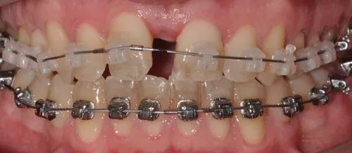 Коррекция прикуса и положения зубов до
