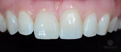 Реставрация зуба после травмы после