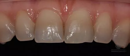 Как происходит удлинение коронковой части зуба